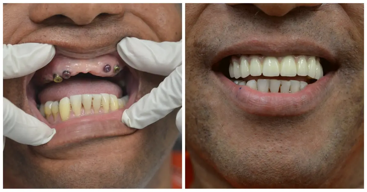 Dental Implants